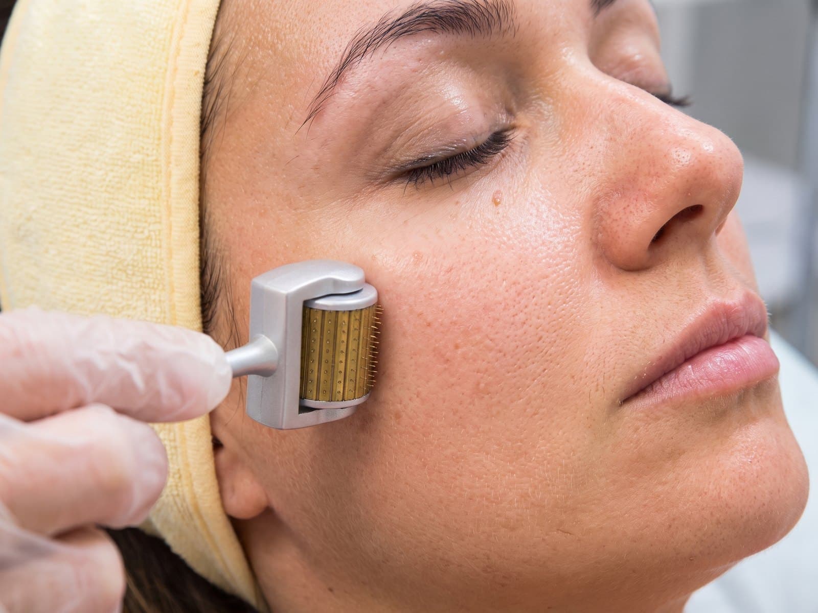 Aplicação de microagulhamento no rosto de uma paciente em consultório de estética